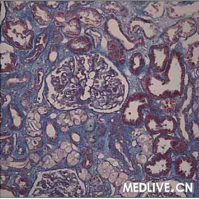 经典病例 > 正文     免疫荧光 可见5个肾小球,iga(-),igg(-),igm节段
