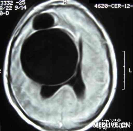 脑包虫病细粒棘球绦虫感染