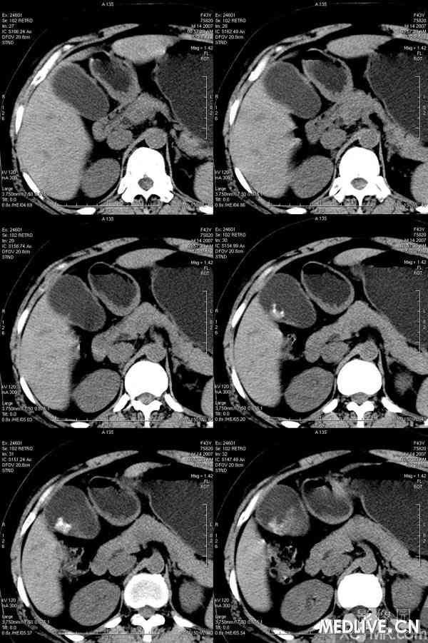 慢性胆囊炎并胆囊结石ct病例图片影像诊断分析_经典病例_医脉通