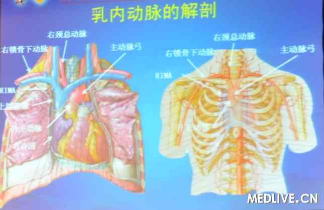 [2011长城会]罕见病例:经桡动脉造影导致右乳内动脉穿孔