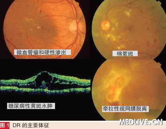 内,眼科应协作防治糖尿病视网膜病变