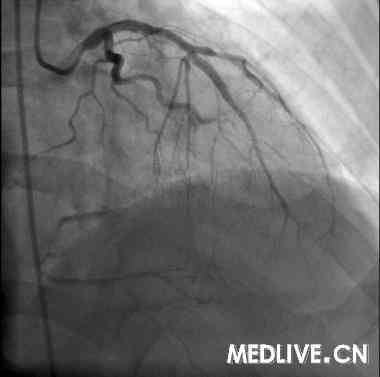 (图1-4)冠状动脉造影pci术后心绞痛劳力型冠心病:入院诊断实验室检查