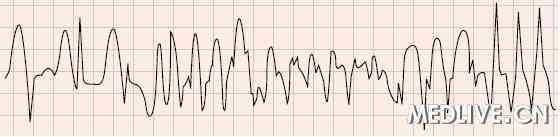 尖端扭转性室速 心电图