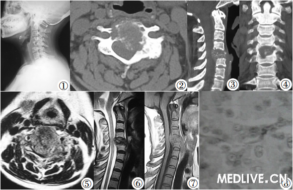 颈椎侵袭性骨母细胞瘤1例