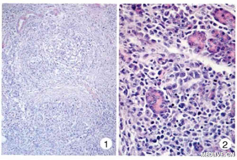 2镜检 镜下见胰腺组织结构部分破坏,部分小叶轮廓保留,破坏区域内可见
