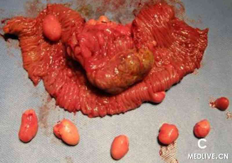 小肠多发脂肪瘤伴肠套叠1例
