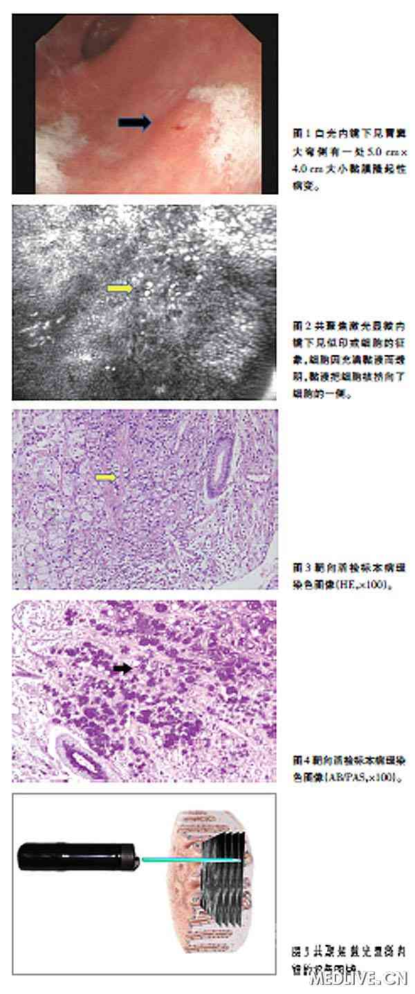 共聚焦激光显微内镜诊断胃印戒细胞癌