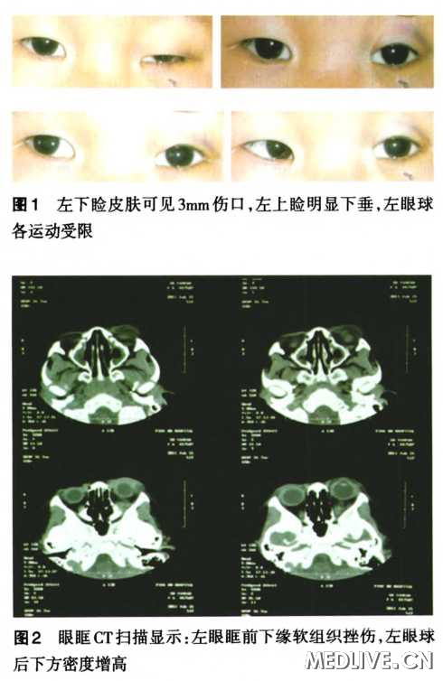 非手术治疗儿童外伤性眶尖综合征一例