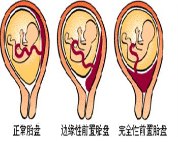 关键词: 凶险型前置胎盘围术期综合手术治疗