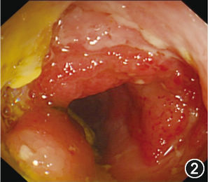 (图2 术前结肠镜示升结肠黏膜炎症)
