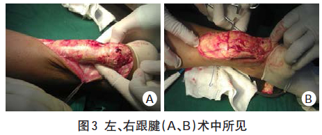 考虑①黄色瘤②跟腱炎(图2.