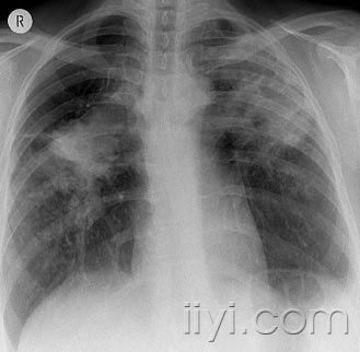肺纤维化进展性大范围平片和ct:心包气肿可以与纵隔气肿相互鉴别,因为