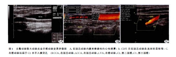 彩色多普勒超声诊断头臂动脉型大动脉炎合并椎动脉变异1例