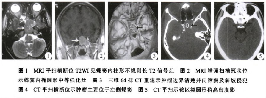 蝶窦斜坡颅骨骨巨细胞瘤误诊为脊索瘤一例报道