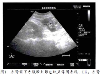 盆腹腔积液,最大深度30 mm;左肾前下方有一混合性包块75 mm×65 mm(图