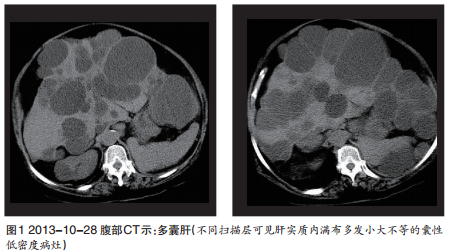 巨大多囊肝继发感染自发破裂1例