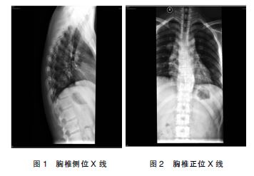 行胸椎正侧位x线检查示(图1,图2:胸椎序列连续,曲度略后凸,胸9椎体略