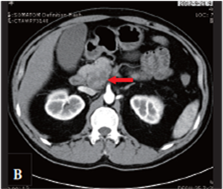 ct 胰腺薄层扫描 三维重建检查显示,胰头钩突部混杂密度占位性病变,实