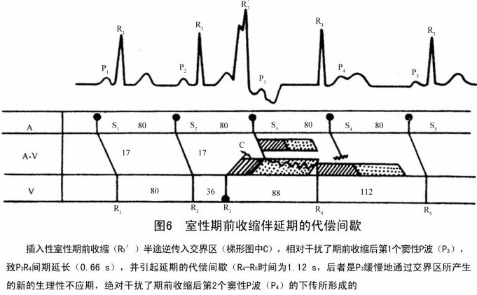 卢喜烈:图解室性期前收缩的代偿间歇