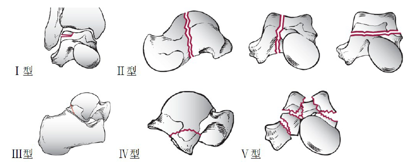 距骨体骨折sneppen分型