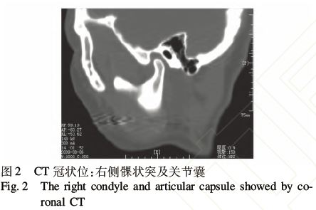 再次修正诊断:左侧下颌骨髁状突肿瘤.1.