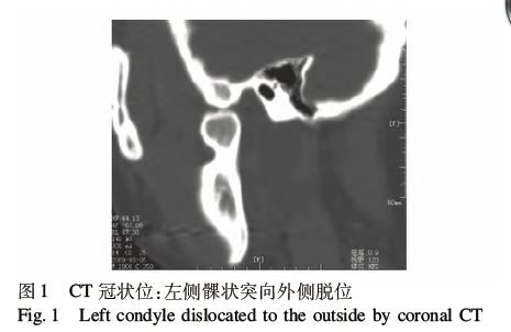 再次修正诊断:左侧下颌骨髁状突肿瘤.1.