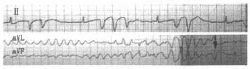 (室速,持续性室速(部分呈尖端扭转型,心室扑动(室扑,心室颤动(室颤