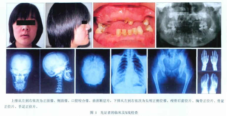 颅锁骨发育不全综合征2例