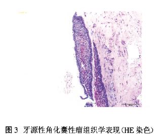 牙源性角化囊性瘤(keratocystic odontogenic tumor,kcot)可发生在