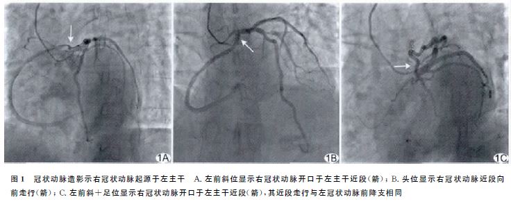 lad)近段狭窄约30,第一对角支(d1)开口狭窄约50,右冠状动脉(right