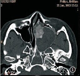 图1 ct 平扫,示左侧筛窦-鼻腔内软组织包块,伴斑块状钙化)及环绕