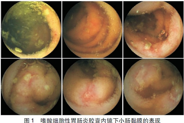 嗜酸细胞性胃肠炎的小肠黏膜表现1例