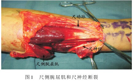 前臂中下段尺动脉走行变异