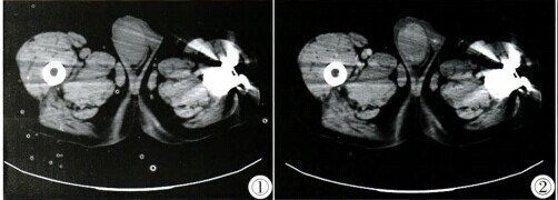 图1,2  ct平扫示右睾丸体积增大,轮廓光整,内部密度均匀,增强后持续