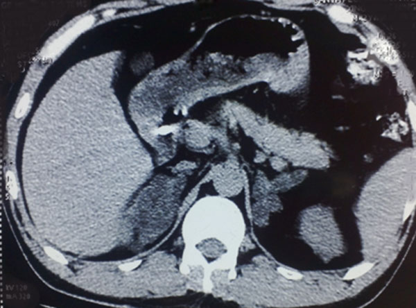 7,肾上腺ct:双侧肾上腺明显增粗呈串珠状,ct值约6-9hu,边缘清楚