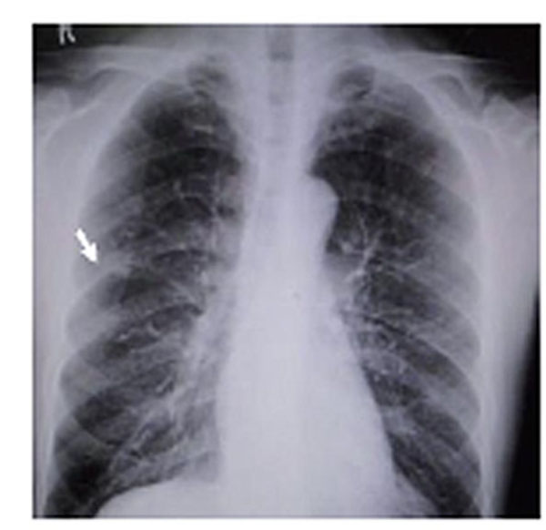 肺脓肿与普通肺炎相鉴别