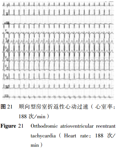 7,二度Ⅱ型及高度,三度房室阻滞二度Ⅱ型房室阻滞心电图特点(1)p波