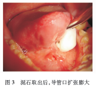 因受涎石压迫,导管口被扩张撑大,红肿(图3,创面涂以结石初诊为黏液腺