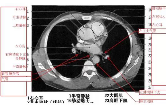 详尽的胸部ct影像示意图上