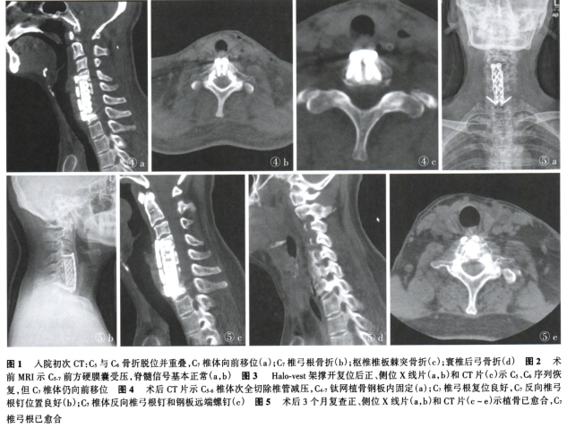 前路反向椎弓根螺钉复位固定下颈椎多节段骨折脱位合并椎弓根骨折