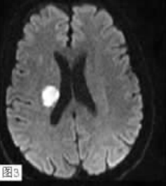 图3 颅脑mri见右侧基底核及右侧放射冠新鲜梗死灶