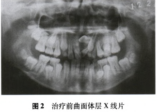 矫治上颌埋伏阻生前牙一例