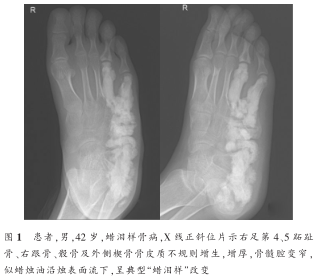 x线片检查示:右足第4,5跖骨,第4近节趾骨,跟骨,骰骨及外侧楔骨骨质