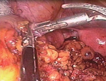 7助手自肛门置入29mm管腔吻合器机身,腔镜下完成乙状结肠直肠端端