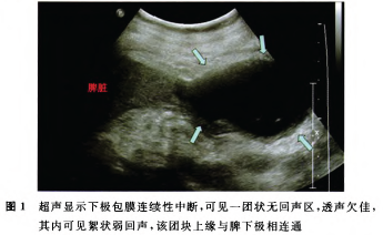 剖宫产术后自发性脾破裂超声表现1例