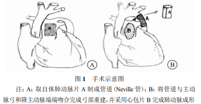 应用肺动脉管道矫治主动脉弓离断后管道重度扩张一例