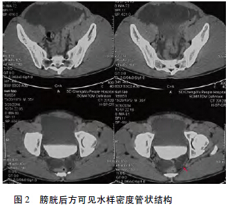 造影检查检查未见异常输尿管口,逆行肾盂造影检查并膀胱镜示左肾区