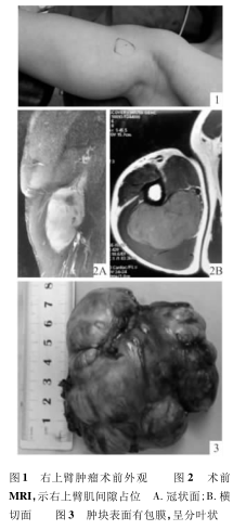 上臂平滑肌肉瘤