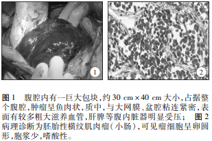 讨论多数横纹肌肉瘤患者早期无明显症状,就诊时均已较晚.