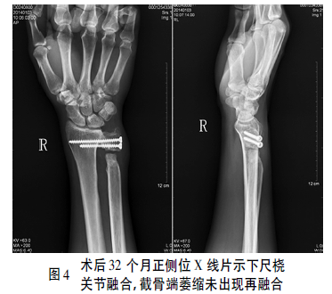 sauvé-kapandji术治疗陈旧性下尺桡关节掌侧脱位1例报告并文献复习